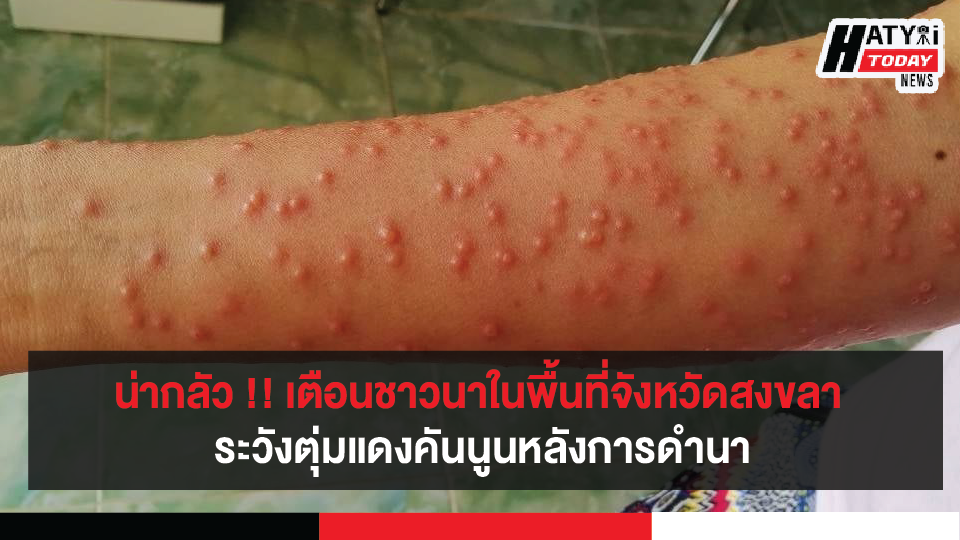 เตือนชาวนาในพื้นที่จังหวัดสงขลา ระวังตุ่มแดงคันนูนหลังการดำนาเบื้องต้นพบผู้ป่วยแล้วหลายราย 15 เตือนชาวนาในพื้นที่จังหวัดสงขลา ระวังตุ่มแดงคันนูนหลังการดำนาเบื้องต้นพบผู้ป่วยแล้วหลายราย