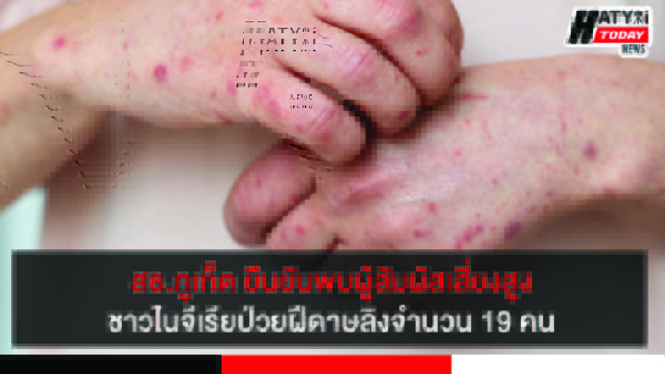 สาธารณสุขจังหวัดภูเก็ต ยืนยันพบผู้สัมผัสเสี่ยงสูงชายชาวไนจีเรียป่วยฝีดาษลิงจำนวน 19 คน