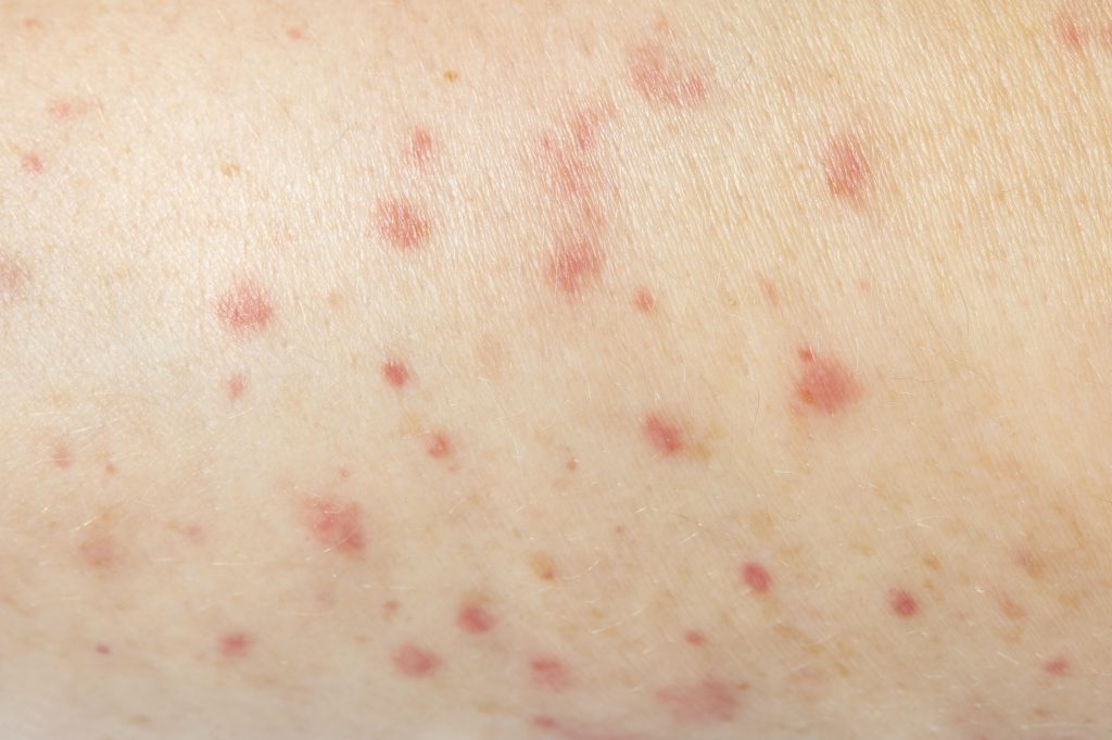 Person Having Skin Allergy Close Up